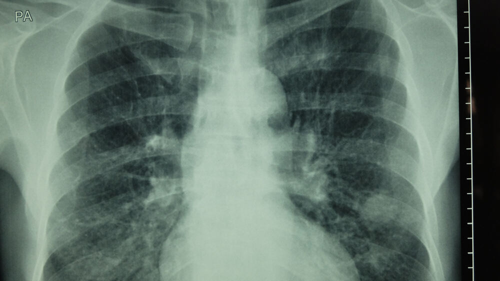 Amy Warburton, RT talks about the Lung Cancer Screening Program